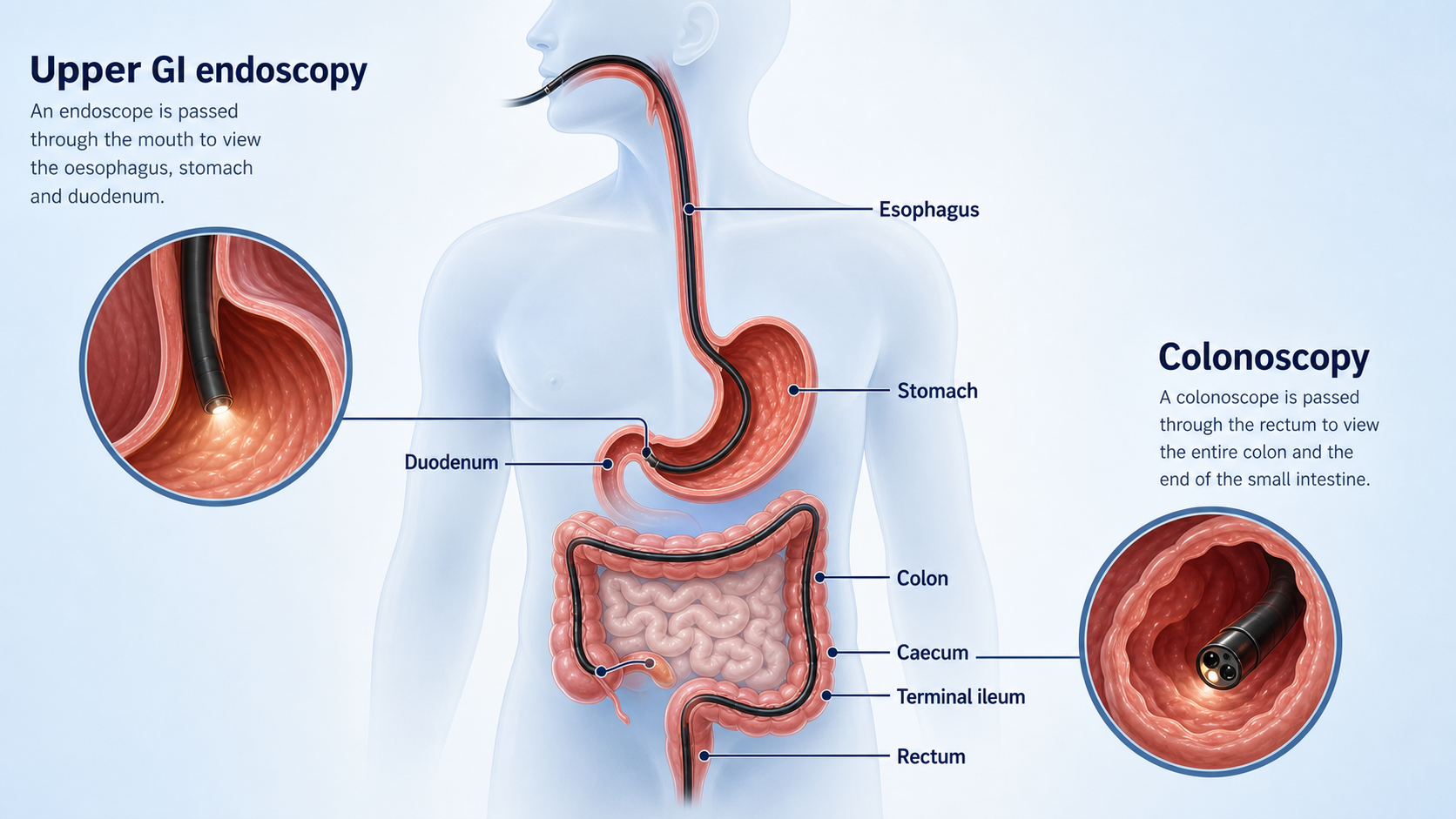 Endoscopy image panel used to illustrate esophageal and upper-GI diagnosis