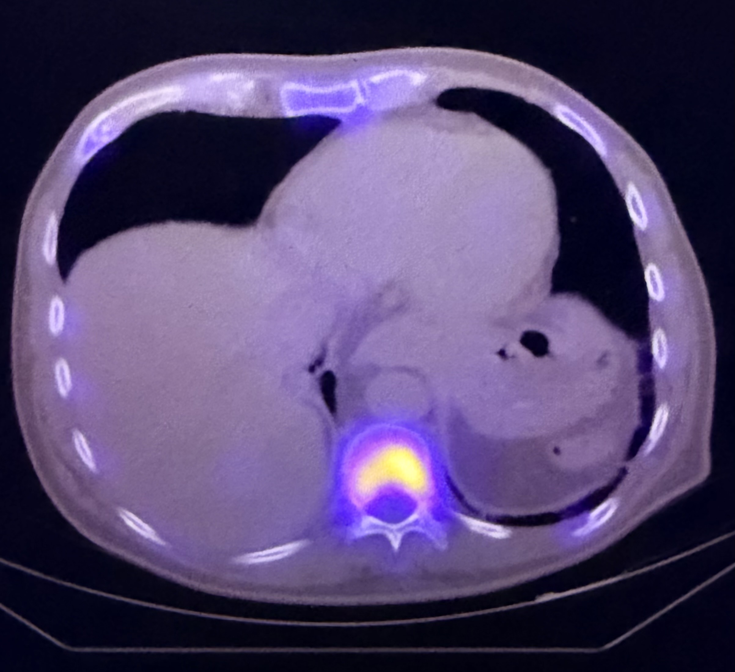 PET/CT example used to illustrate metastatic staging